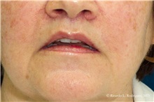 Lip Augmentation/Enhancement After Photo by Ricardo Rodriguez, MD; Lutherville-Timonium, MD - Case 32581