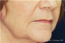 Lip Augmentation/Enhancement Before Photo by Ricardo Rodriguez, MD; Lutherville-Timonium, MD - Case 32581