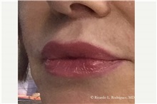 Lip Augmentation/Enhancement After Photo by Ricardo Rodriguez, MD; Lutherville-Timonium, MD - Case 32582