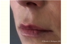 Lip Augmentation/Enhancement Before Photo by Ricardo Rodriguez, MD; Lutherville-Timonium, MD - Case 32582