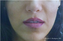 Lip Augmentation/Enhancement After Photo by Ricardo Rodriguez, MD; Lutherville-Timonium, MD - Case 32583
