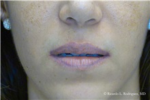 Lip Augmentation/Enhancement Before Photo by Ricardo Rodriguez, MD; Lutherville-Timonium, MD - Case 32583
