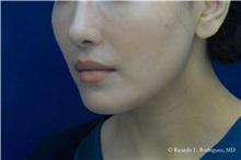 Lip Augmentation/Enhancement After Photo by Ricardo Rodriguez, MD; Lutherville-Timonium, MD - Case 32584
