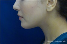 Lip Augmentation/Enhancement After Photo by Ricardo Rodriguez, MD; Lutherville-Timonium, MD - Case 32584