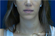 Lip Augmentation/Enhancement Before Photo by Ricardo Rodriguez, MD; Lutherville-Timonium, MD - Case 32585