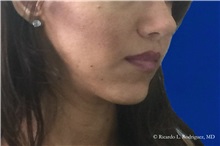 Lip Augmentation/Enhancement After Photo by Ricardo Rodriguez, MD; Lutherville-Timonium, MD - Case 32585