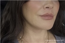 Lip Augmentation/Enhancement After Photo by Ricardo Rodriguez, MD; Lutherville-Timonium, MD - Case 32586