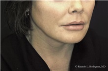 Lip Augmentation/Enhancement Before Photo by Ricardo Rodriguez, MD; Lutherville-Timonium, MD - Case 32586
