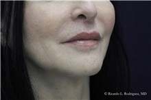 Lip Augmentation/Enhancement After Photo by Ricardo Rodriguez, MD; Lutherville-Timonium, MD - Case 32587