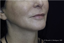 Lip Augmentation/Enhancement Before Photo by Ricardo Rodriguez, MD; Lutherville-Timonium, MD - Case 32587