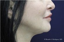 Lip Augmentation/Enhancement After Photo by Ricardo Rodriguez, MD; Lutherville-Timonium, MD - Case 32587