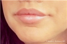 Lip Augmentation/Enhancement After Photo by Ricardo Rodriguez, MD; Lutherville-Timonium, MD - Case 32588