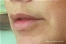 Lip Augmentation/Enhancement Before Photo by Ricardo Rodriguez, MD; Lutherville-Timonium, MD - Case 32588