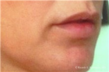 Lip Augmentation/Enhancement Before Photo by Ricardo Rodriguez, MD; Lutherville-Timonium, MD - Case 32588