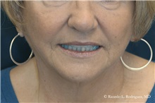 Facelift After Photo by Ricardo Rodriguez, MD; Lutherville-Timonium, MD - Case 32590