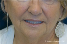 Facelift Before Photo by Ricardo Rodriguez, MD; Lutherville-Timonium, MD - Case 32590