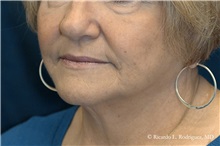 Facelift After Photo by Ricardo Rodriguez, MD; Lutherville-Timonium, MD - Case 32590