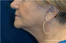 Facelift After Photo by Ricardo Rodriguez, MD; Lutherville-Timonium, MD - Case 32590