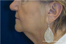 Facelift Before Photo by Ricardo Rodriguez, MD; Lutherville-Timonium, MD - Case 32590
