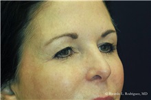 Brow Lift Before Photo by Ricardo Rodriguez, MD; Lutherville-Timonium, MD - Case 32591