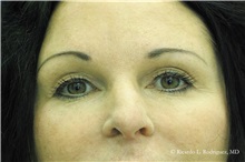 Brow Lift After Photo by Ricardo Rodriguez, MD; Lutherville-Timonium, MD - Case 32591