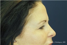 Brow Lift Before Photo by Ricardo Rodriguez, MD; Lutherville-Timonium, MD - Case 32591