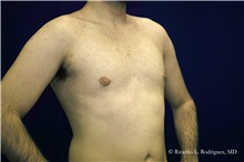 Male Breast Reduction After Photo by Ricardo Rodriguez, MD; Lutherville-Timonium, MD - Case 32592