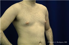 Male Breast Reduction Before Photo by Ricardo Rodriguez, MD; Lutherville-Timonium, MD - Case 32592