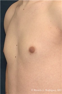 Male Breast Reduction After Photo by Ricardo Rodriguez, MD; Lutherville-Timonium, MD - Case 32594