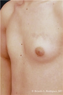 Male Breast Reduction Before Photo by Ricardo Rodriguez, MD; Lutherville-Timonium, MD - Case 32594