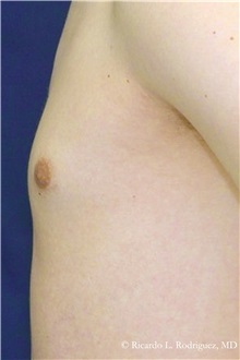 Male Breast Reduction After Photo by Ricardo Rodriguez, MD; Lutherville-Timonium, MD - Case 32594
