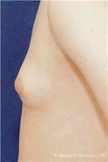 Male Breast Reduction Before Photo by Ricardo Rodriguez, MD; Lutherville-Timonium, MD - Case 32594