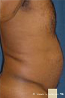 Liposuction Before Photo by Ricardo Rodriguez, MD; Lutherville-Timonium, MD - Case 32610