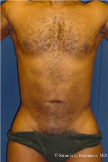 Liposuction After Photo by Ricardo Rodriguez, MD; Lutherville-Timonium, MD - Case 32611