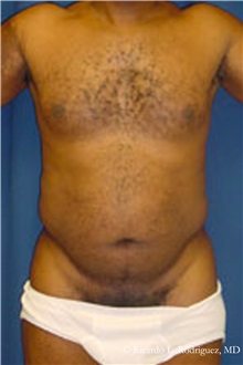 Liposuction Before Photo by Ricardo Rodriguez, MD; Lutherville-Timonium, MD - Case 32611