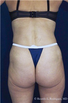 Liposuction After Photo by Ricardo Rodriguez, MD; Lutherville-Timonium, MD - Case 32613