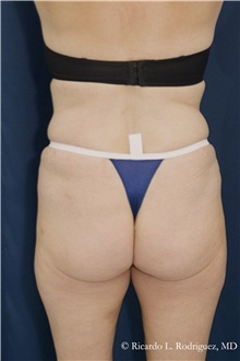 Liposuction Before Photo by Ricardo Rodriguez, MD; Lutherville-Timonium, MD - Case 32613