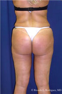 Liposuction After Photo by Ricardo Rodriguez, MD; Lutherville-Timonium, MD - Case 32615