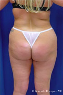 Liposuction Before Photo by Ricardo Rodriguez, MD; Lutherville-Timonium, MD - Case 32615