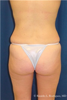 Liposuction After Photo by Ricardo Rodriguez, MD; Lutherville-Timonium, MD - Case 32617