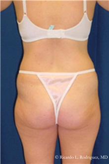 Liposuction Before Photo by Ricardo Rodriguez, MD; Lutherville-Timonium, MD - Case 32617