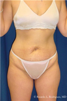 Liposuction Before Photo by Ricardo Rodriguez, MD; Lutherville-Timonium, MD - Case 32617