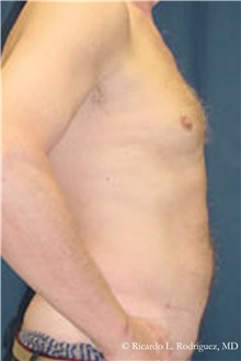 Liposuction After Photo by Ricardo Rodriguez, MD; Lutherville-Timonium, MD - Case 32618