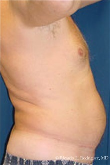 Liposuction Before Photo by Ricardo Rodriguez, MD; Lutherville-Timonium, MD - Case 32618