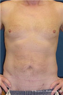Liposuction After Photo by Ricardo Rodriguez, MD; Lutherville-Timonium, MD - Case 32618