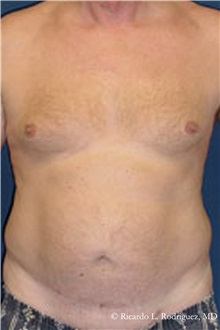 Liposuction Before Photo by Ricardo Rodriguez, MD; Lutherville-Timonium, MD - Case 32618