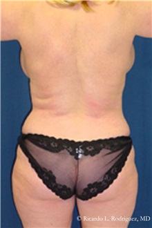 Liposuction After Photo by Ricardo Rodriguez, MD; Lutherville-Timonium, MD - Case 32620