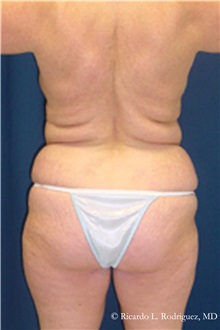 Liposuction Before Photo by Ricardo Rodriguez, MD; Lutherville-Timonium, MD - Case 32620