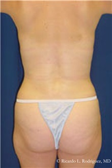Liposuction After Photo by Ricardo Rodriguez, MD; Lutherville-Timonium, MD - Case 32621