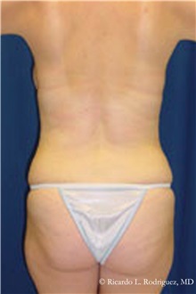 Liposuction Before Photo by Ricardo Rodriguez, MD; Lutherville-Timonium, MD - Case 32621